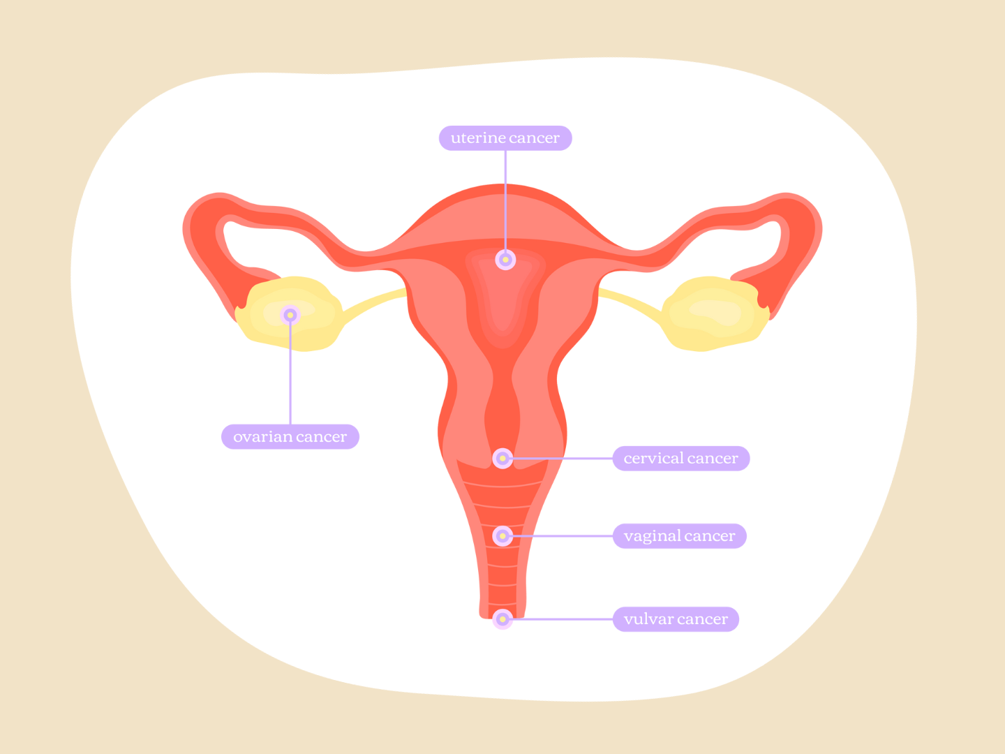 An illustration of a reproductive system including uterus, fallopian tubes, ovaries, cervix, and vagina, with each part labelled.