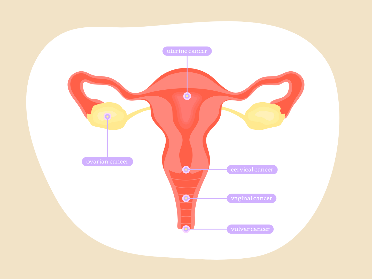 The Breasties Guide to Gynecologic Cancers